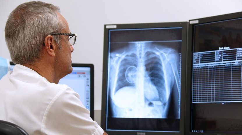 Deep Learning para detectar tumores pulmonares